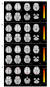 뇌 기능적 자기공명영상(fMRI). 붉은색으로 표시된 부분이 연결성이 뚜렷이 증가한 부위를 나타낸다. A는 디젤 배기가스 노출 전과 후에 중요한 변화가 없음을 나타낸다. B는 깨끗한 공기 노출 전과 후에 연결성이 증가한 것을 보여준다. C는 디젤 배기 노출 전의 영상과 깨끗한 공기 노출 전의 영상을 비교, 디젤 배출 전에 연결성이 더 높은 사례를 보여준다. D는 깨끗한 공기 노출 후와 디젤 배기가스 노출 후를 비교, 깨끗한 공기에 노출됐을 때 기능적 연결성이 더 큰 영역을 나타낸다. 깨끗한 공기 속에서 운동한 경우 연결성이 증가하는데(B사례), 오염된 공기에 노출됐을 때와 비교하면 차이가 확연하다(D사례). [자료: Environmental Health, 2023]