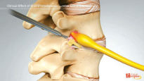 [헬스&뷰티] 수술적 기법 가미된 시술법 ‘추간공확장술’로 척추질환 치료 효과 높여