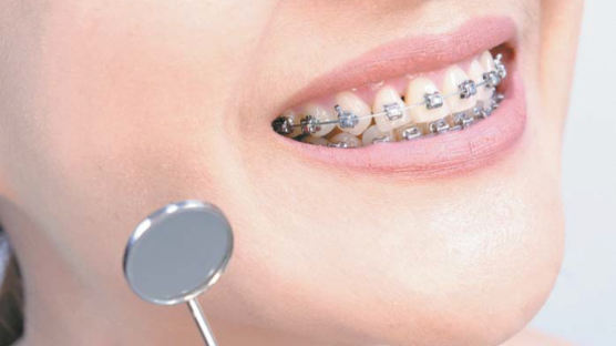 [건강한 가족] 치아 교정기 변형 막고 효과 오래가려면 … ‘딱딱·질겅·끈적’ 피하세요
