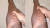  영국 원반던지기 국가대표 로렌스 오코예가 엄지손가락으로 자신의 정강이를 누르자 손가락 모양대로 파이는 자국이 남는다. 이는 그가 겪은 질병 봉와직염 때문인 것으로 밝혀졌다. 오코예 틱톡 캡처