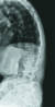 골다공증이 생긴 70대 여성 환자의 X선 사진. 골밀도가 줄면서 일부 허리뼈가 눌려 있다. [사진 세브란스병원]