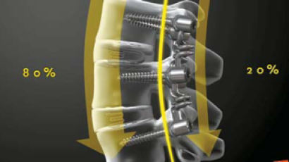 [헬스&뷰티] 10년 전 척추 수술 환자 90%, 반강성고정술 후 연접부 퇴행 변화 없어