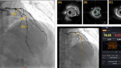 복잡한 스텐트 수술에도 AI 활용..."180만원 초음파검사 대체 가능"