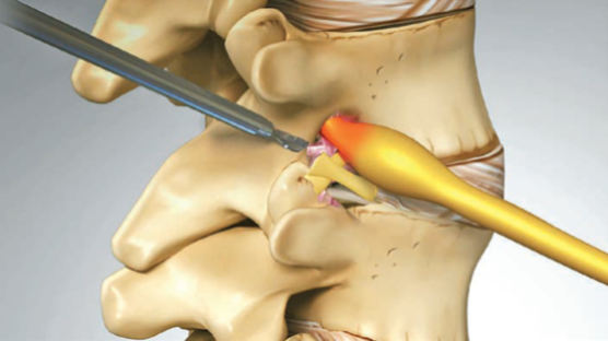 [헬스&뷰티] 참기 힘든 척추 통증, 관리해도 지속된다면 추간공확장술이 대안