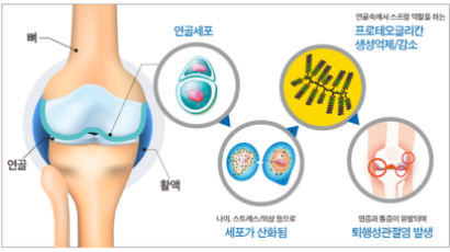 [건강한 우리집] 삶의 질 떨어트리는 관절염 통증, 연골세포 손상 때문