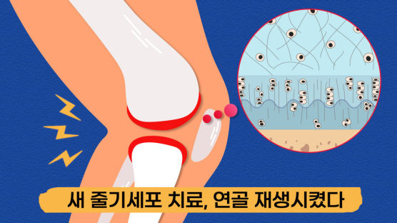 퇴행성 관절염 못 고친다? 연골 되돌리는 약 나온다