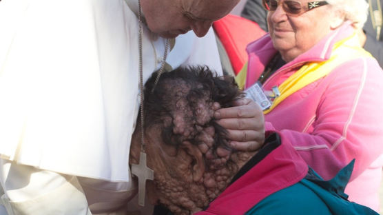 혹 뒤덮인 얼굴에 교황 '축복 키스' 받았다…세계 울린 그, 결국