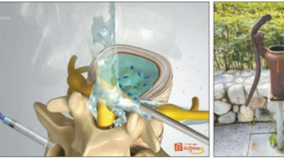 [헬스&바이오] 수동 물펌프 원리로 막힌 척추관·추간공 뚫어 치료 ‘추간공확장술’ 주목