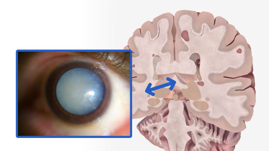 눈 침침, 백내장 진단 ‘조심’…치매 12년 전 예측하는 ‘눈’