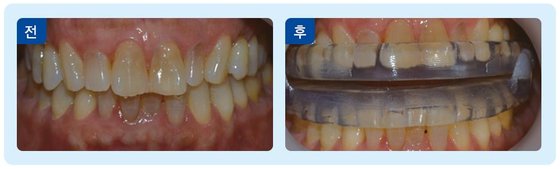 드르렁 코골며, 자다 말고 '컥컥'…놔두면 뇌졸중·심장병 부른다