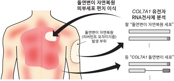 '약한 마찰에도 상처·수포' 희귀 피부질환, 국내서 치료법 찾아