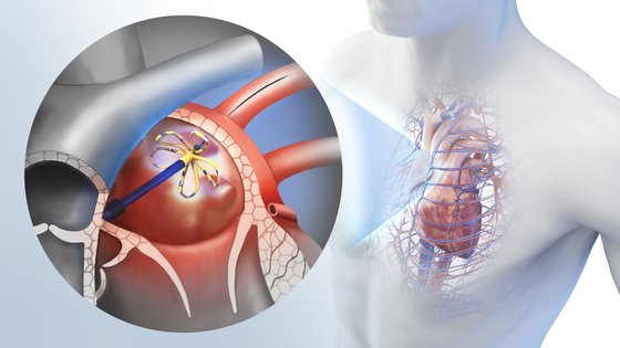 펄스장 절제술(Pulsed Field Ablation, PFA)은 고에너지 전기 펄스를 이용해 심방세동을 일으키는 비정상 전기신호가 발생한 심근세포만 선택적으로 정확히 제거한다. 사진 삼성서울병원