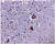 2 파킨슨 뇌세포(흑질부위) 루이소체(갈색, 알파큐늘레인 단백질엉김체)