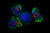 암세포(중앙)를 둘러싼 면역T세포들. 예방주사는 이런 특정 면역세포들을 미리 준비케 한다. 쥐를 대상으로 한 암 예방주사 실험이 성공했다.