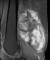 MRI 검사에서 발견된 허벅지 내 육종암. 밝은 색으로 보이는 10㎝ 가량의 종괴가 관찰된다. [사진 삼성서울병원]