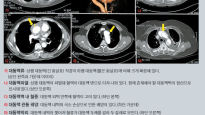 대동맥 이상 땐 치명적…가족력·고령자 정기 CT 검사를