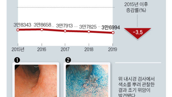 크기 2㎝ 이내 조기 위암, 개복 않고 내시경 절제 가능