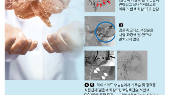 이명·안구충혈 지속 땐 뇌출혈 유발 ‘동정맥루’ 의심해야